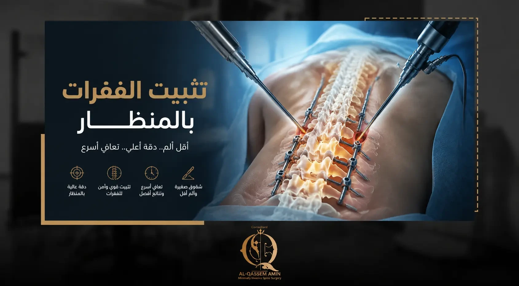 تثبيت الفقرات بالمنظار