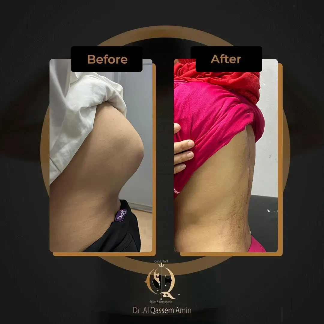 علاج تحدب الظهر بعد سن 18