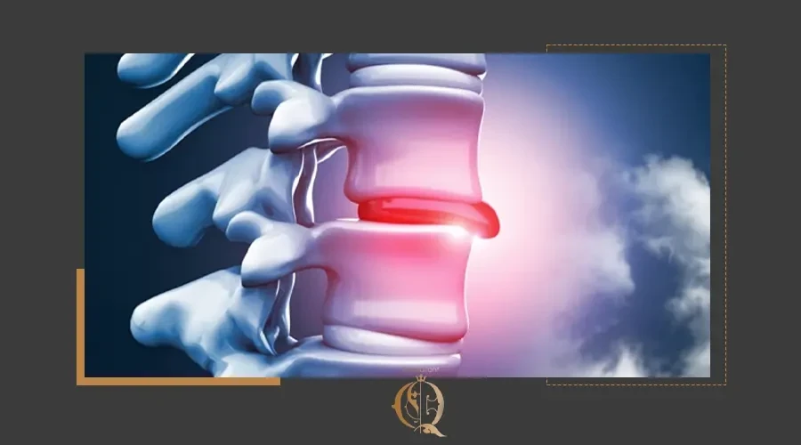 عملية استئصال الغضروف وتثبيت الفقرات